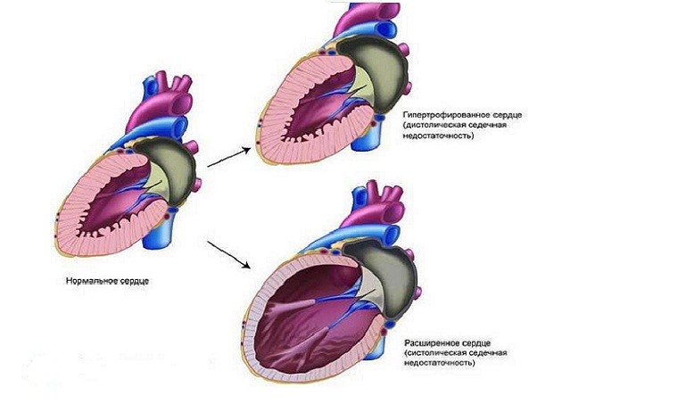 Морфофункциональные особенности диафрагмы у больных с хронической сердечной недостаточностью