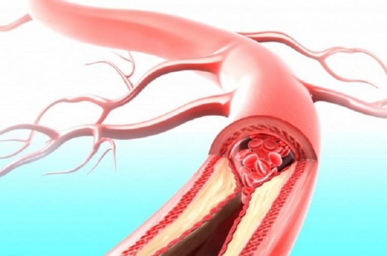 Субклинический атеросклероз сонных артерий у пациентов с традиционными факторами сердечно-сосудистого риска