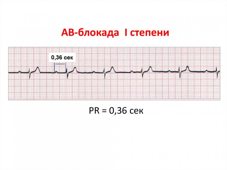 Клинический случай псевдо-синдрома электрокардиостимулятора вследствие выраженной атриовентрикулярной блокады I степени.