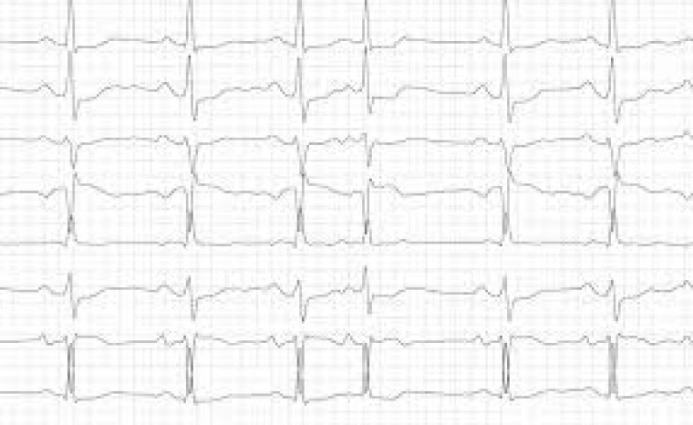Лечение хронической сердечной недостаточности с сохраненной фракцией выброса левого желудочка у пациентов с гипертонической болезнью: потенциальная роль статинов