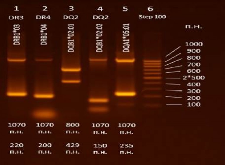 Частота hla-drb1 аллелей и генотипов у пациентов с аццп-позитивным вариантом ревматоидного артрита и их родственников 1-й и 2-й степеней родства