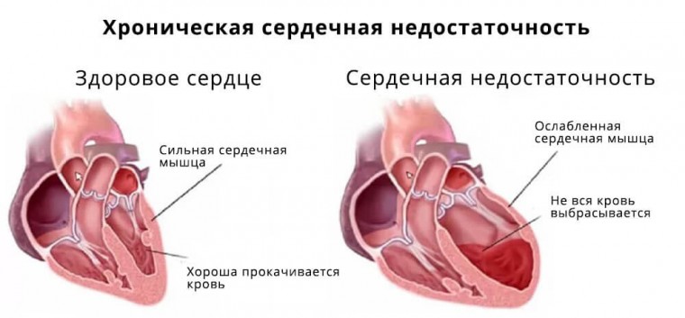 Значения некоторых биомаркеров при хронической сердечной недостаточности, обусловленной идиопатической дилатационной и ишемической кардиомиопатией