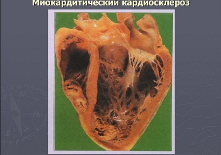 Миокардитический кардиосклероз неревматической этиологии как  нозологическая форма в структуре некоронарогенных желудочковых аритмий