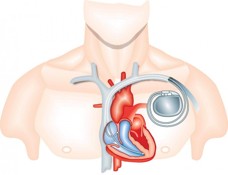 Способ экстракции петли электрода постоянной кардиостимуляции из правых отделов сердца через бедренный доступ