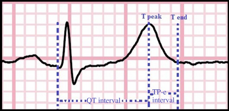 TP-E интервал и его взаимосвязи у пациентов с хронической ишемической болезнью сердца