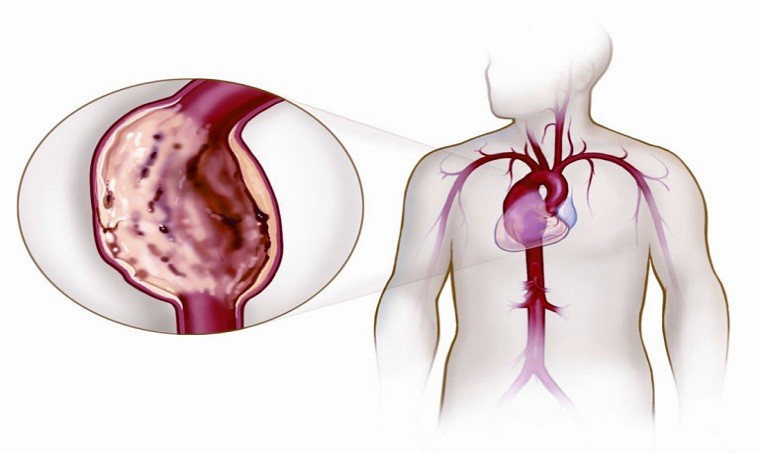 Наднациональные (международные) рекомендации по наследуемым аневризмам и расслоениям грудной аорты