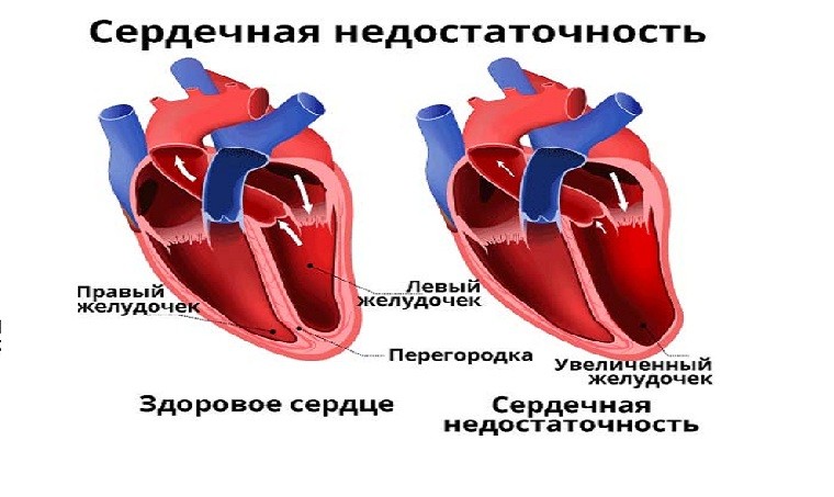 Вклад пневмонии в смертность коморбидного пациента с хронической сердечной недостаточностью