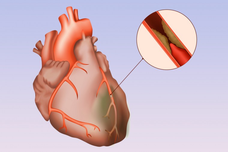 Ischemia - крупнейшее в истории рандомизированное исследование по стабильной ишемической болезни сердца. Исходные характеристики включенных пациентов на примере российского центра