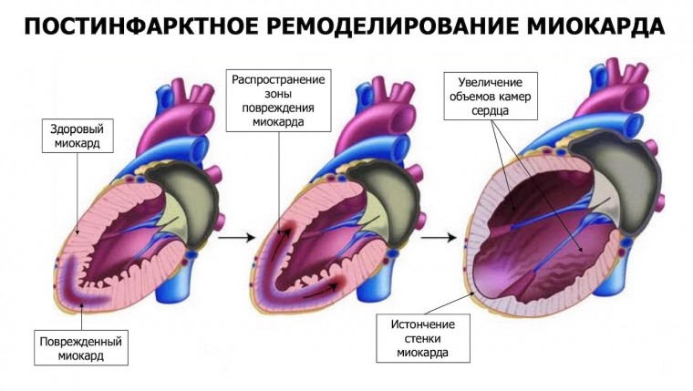 Использование параметров тканевого допплеровского исследования для прогнозирования постинфарктного ремоделирования левого желудочка