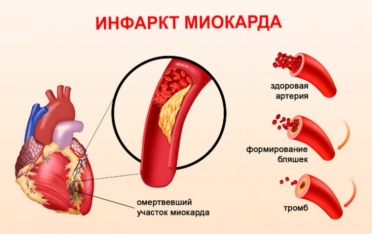 Неинвазивная оценка результатов тромболитической терапии при остром инфаркте миокарда с помощью анализа профилей концентрации сердечных ферментов