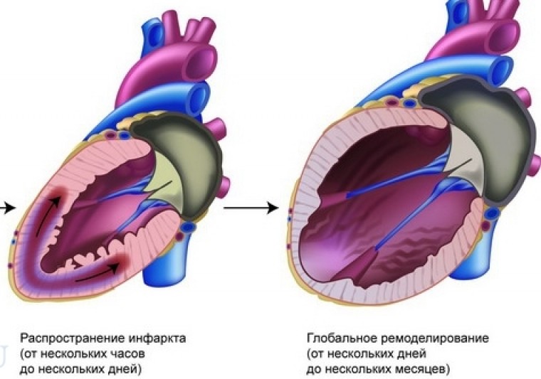 Прогнозирование постинфарктного ремоделирования левого желудочка