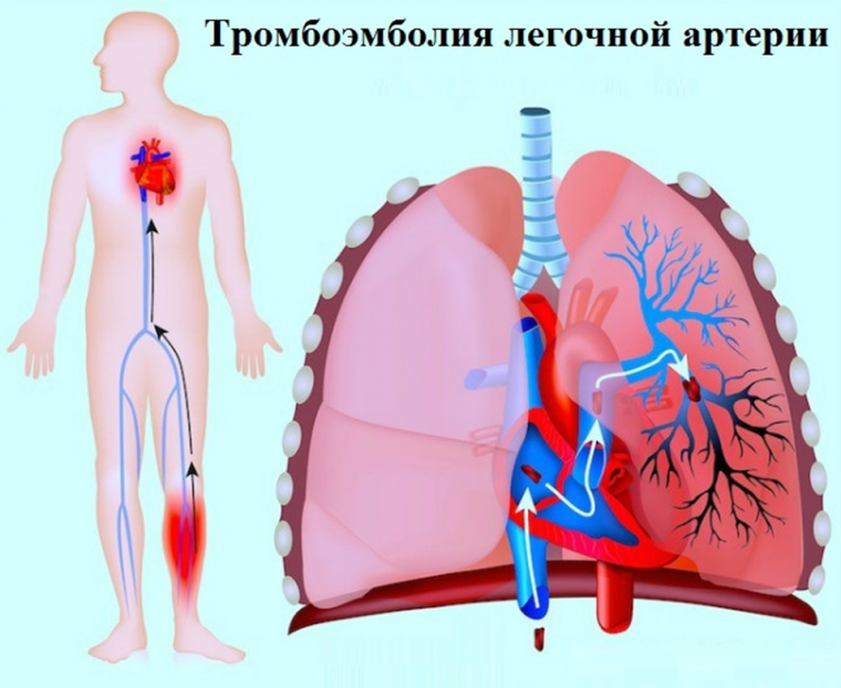 Современные подходы к диагностике, лечению и профилактике тромбоэмболии легочной артерии