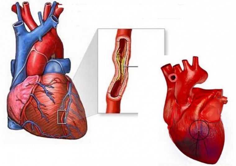 Эффективность стратегии высокого риска в прогнозировании первичной манифестации ишемической болезни сердца