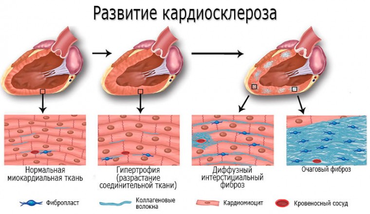 Исследование взаимосвязи между эхокардиографическими показателями ремоделирования и функцией левого желудочка у пациентов с постинфарктным кардиосклерозом