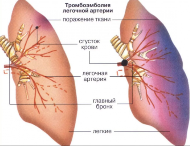 Тромбоэмболия легочной артерии: клинические проявления и диагностика в свете новых рекомендаций Европейского общества кардиологов
