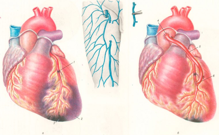 Влияние реваскуляризации у больных острым инфарктом миокарда на течение ишемической болезни сердца в постинфарктном периоде