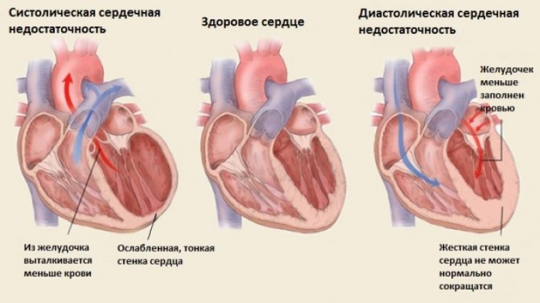 Влияние способов реваскуляризации в остром периоде инфаркта миокарда на течение хронической сердечной недостаточности и структурно-функциональное ремоделирование сердца