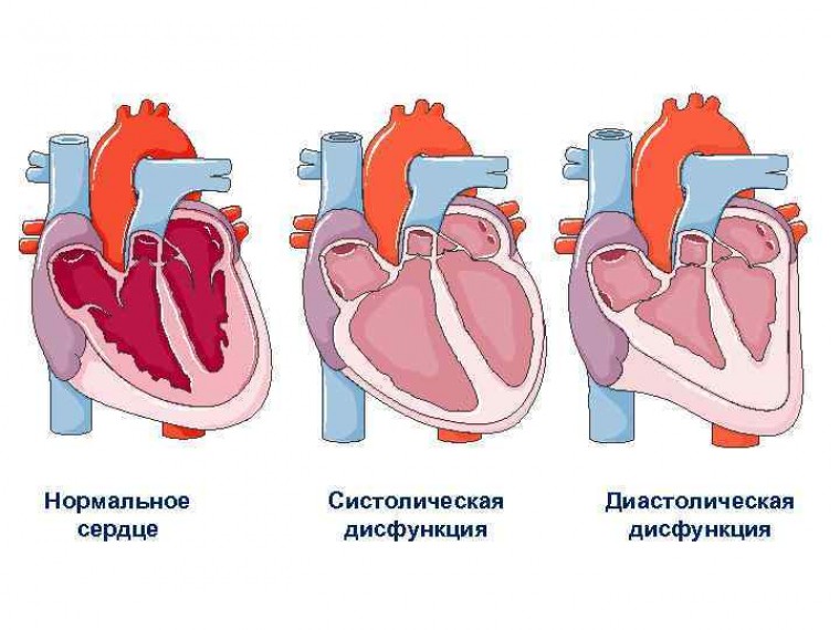 Динамика показателей систолической функции левого желудочка у больных с разными способами реваскуляризации в остром периоде инфаркта миокарда с учетом приверженности терапии