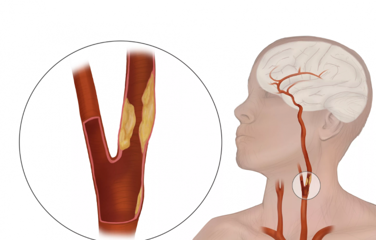 Стентирование внутренних сонных артерий в ранние сроки острого ишемического инсульта