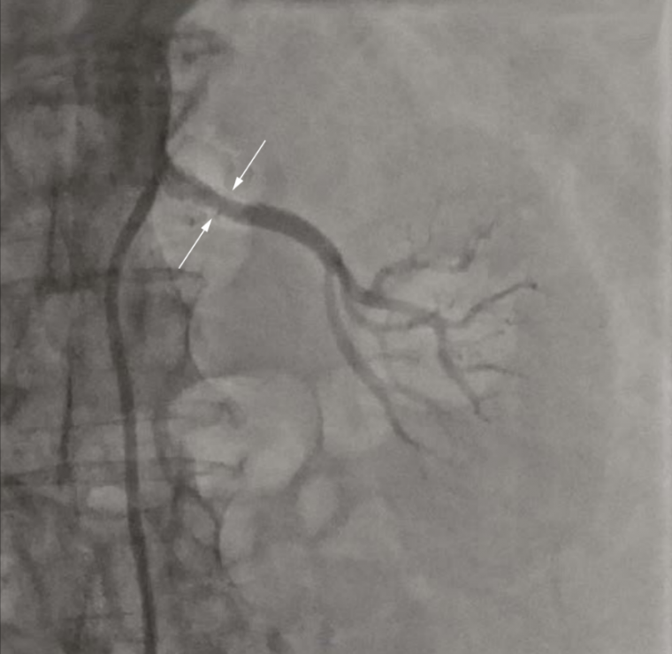 Лечение пациента с резистентной артериальной гипертензией и фибрилляцией предсердий методом радиочастотной абляции в почечных артериях и левом предсердии