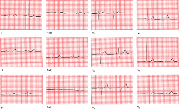 Левожелудочковая гипертрофия и нарушения сердечного ритма при гипертонической болезни