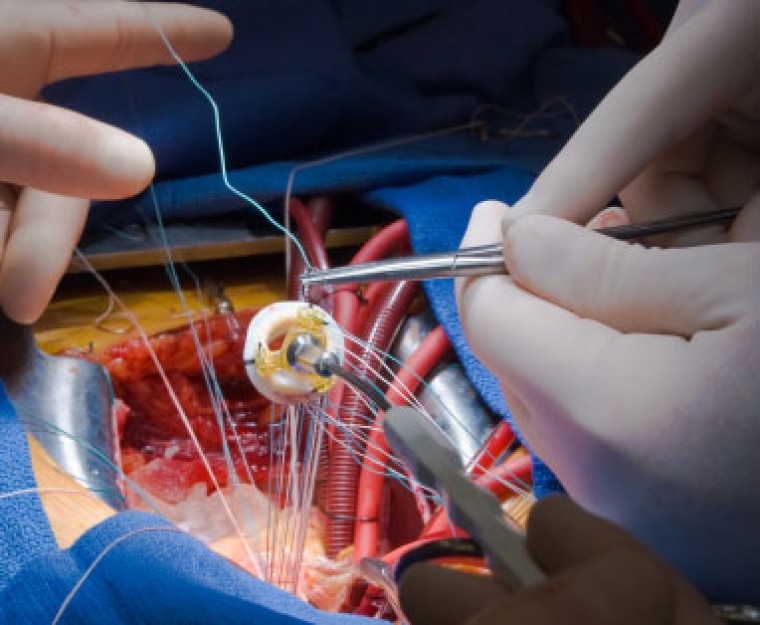 Влияние первичной коронарной баллонной ангиопластики на систолическую функцию левого желудочка у больных с острой сердечной недостаточностью и инфарктом миокрада с зубцом Q нижней локализации