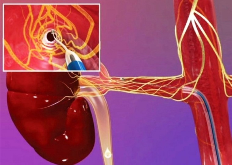 Новый метод лечения резистентной артериальной гипертензии посредством симпатической денервации почечных артерий