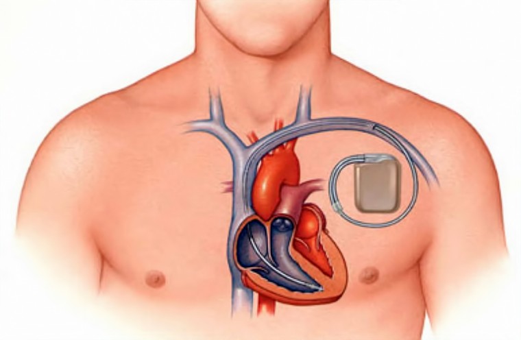 Влияние постоянной двухкамерной электрокардиостимуляции на вариабельность сердечного ритма у больных гипертрофической кардиомиопатией