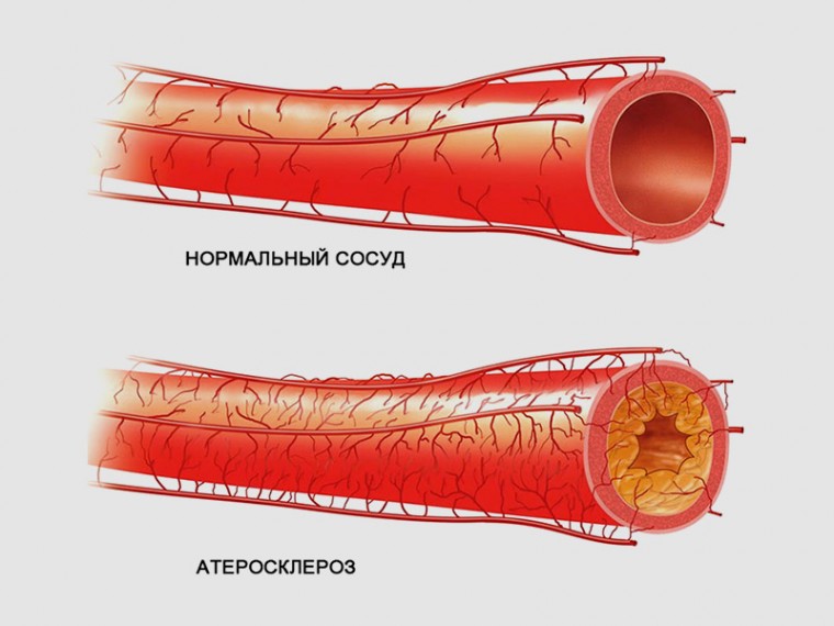 Атеросклероз у пациентов с ревматоидным артритом: роль некоторых показателей воспаления и эндотелиальной функции