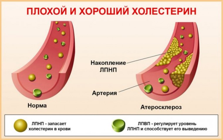 Атеросклероз у пациентов с ревматоидным артритом: роль окисленных липопротеинов низкой плотности