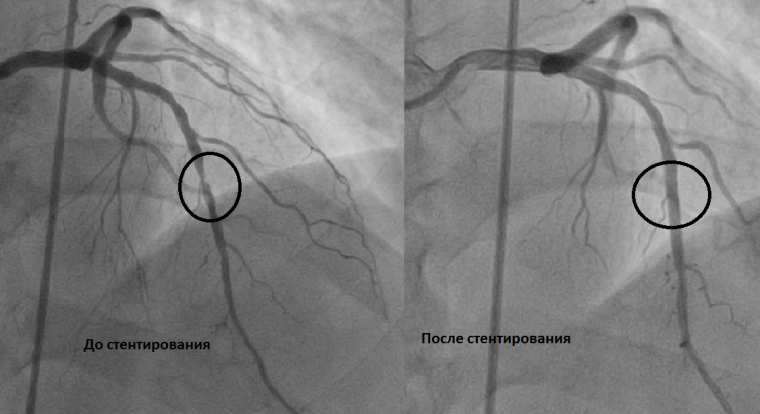 Влияние стенозов в бассейне инфарктнезависимой коронарной артерии на развитие острой сердечной недостаточности у пациентов с Q-инфарктом миокарда нижней локализации