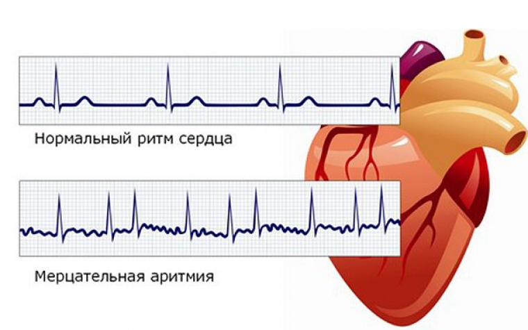 Способ моделирования пароксизмальной аритмии сердца