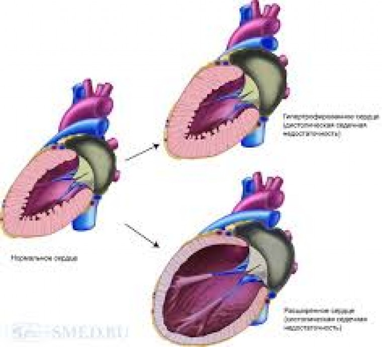 Лечение хронической сердечной недостаточности с сохраненной фракцией выброса левого желудочка: сравнение двух вариантов терапии, урежающей ритм сердца