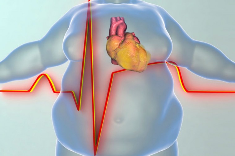 Влияние висцерального ожирения на формирование постинфарктной геометрии левого желудочка, возможности реадаптации к физической нагрузке данной категории лиц