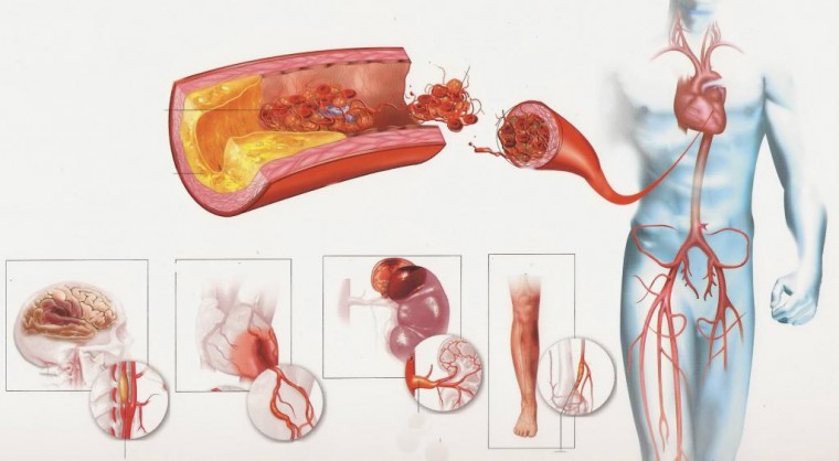 Влияние секреторной активности жировой ткани на функциональное состояние эндотелия и особенности атеросклеротического поражения коронарного русла у пациентов с постинфарктным кардиосклерозом на фоне абдоминального ожирения