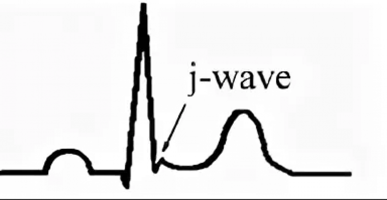 Пересмотр диагностических критериев синдромов J-волны: новые концепции и их актуальность для практики кардиолога