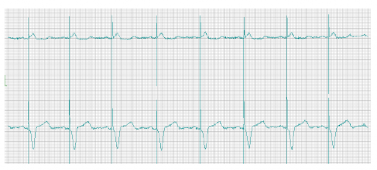 Антитахикардическая электрокардиостимуляция — АТЭКС у пациентов с имплантированными кардиовертерами-дефибрилляторами