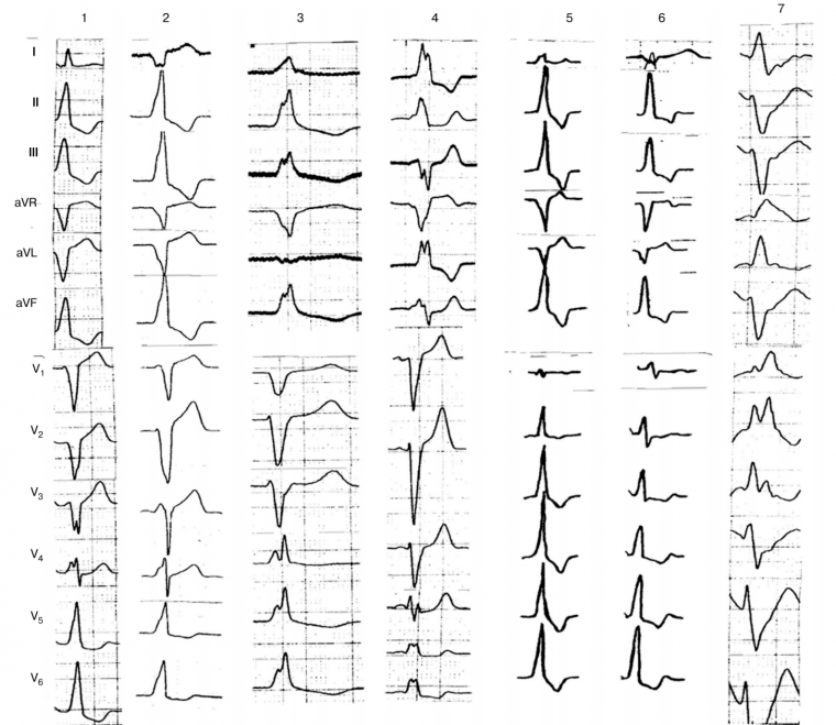 Некоронарогенные желудочковые нарушения ритма сердца: классификация, клинические проявления, диагностика и лечение
