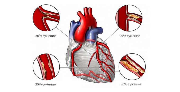 Цереброваскулярные ишемические осложнения крупноочагового инфаркта миокарда