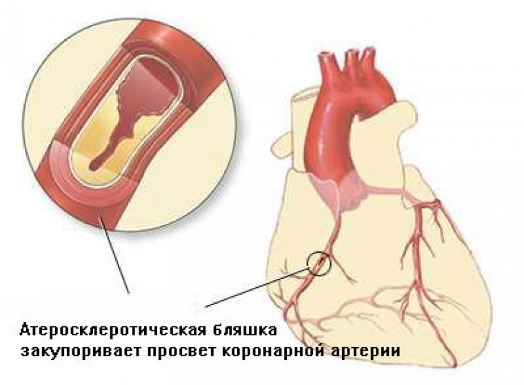 Функциональное состояние эндотелия у больных ишемической болезнью сердца в сочетании с сахарным диабетом