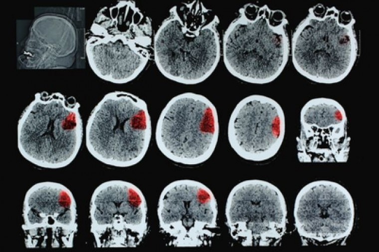 Факторы риска ишемического повреждения мозга и ранних неблагоприятных исходов у пациентов с острым крупноочаговым инфарктом миокарда