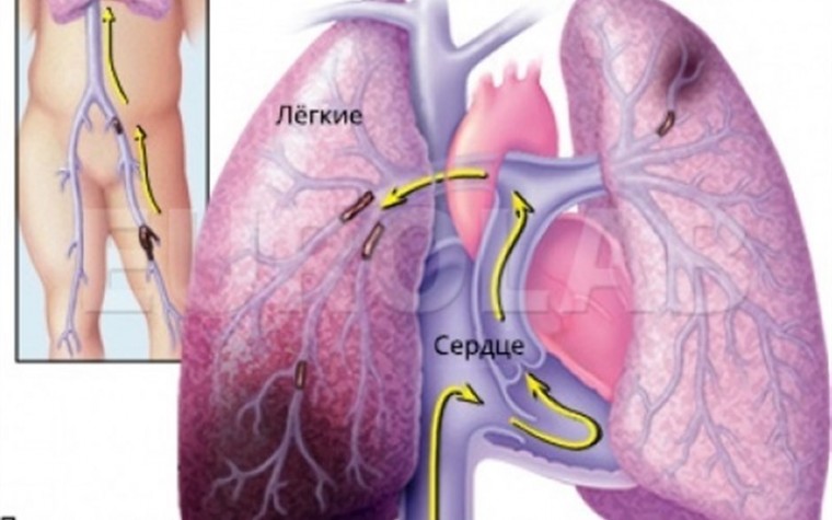 Тромбоэмболия легочной артерии: особенности течения на фоне хронической сердечной недостаточности