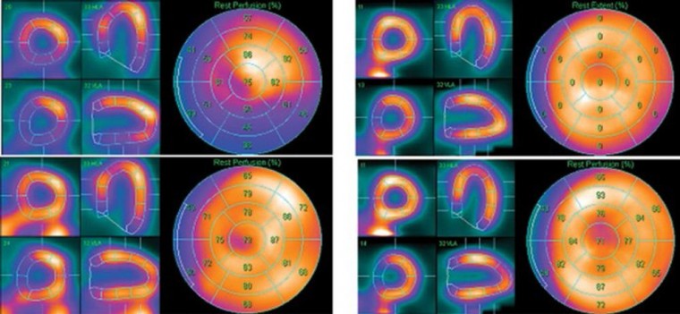 Состояние перфузии миокарда по данным однофотонной эмиссионной компьютерной томографии у женщин в постменопаузальном периоде