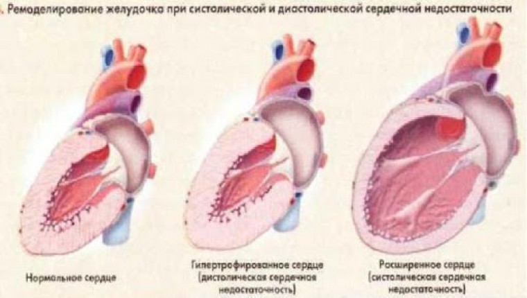 Постинфарктное ремоделирование левого желудочка: некоторые патогенетические аспекты