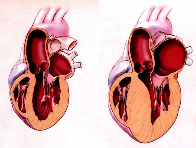 Особенности ремоделирования левого желудочка при инфаркте миокарда после первичной коронарной ангиопластики
