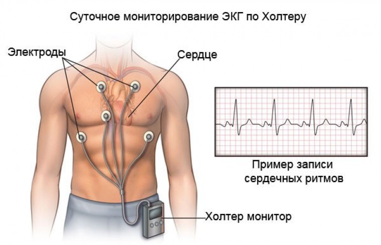 Значение динамики частоты сердечных сокращений по данным холтеровского мониторирования электрокардиограммы в диагностике синдрома слабости синусового узла