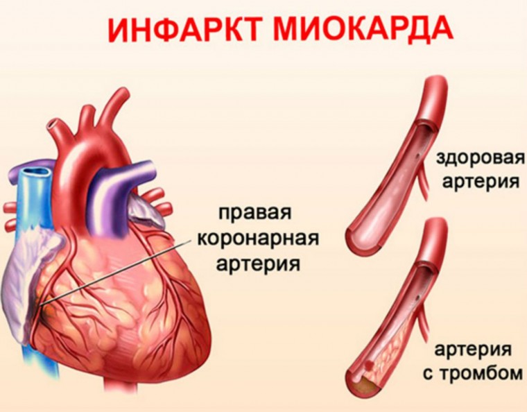 Инфаркт миокарда: патофизиологические механизмы развития, диагностическая стратегия и тактика лечения