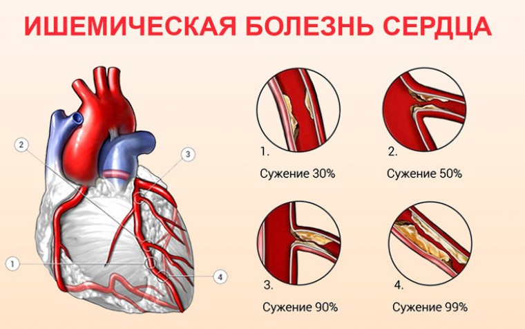 Липидный профиль у пациентов с ишемической болезнью сердца в зависимости от полиморфизмов bsmi и foki гена vdr и содержания витамина d