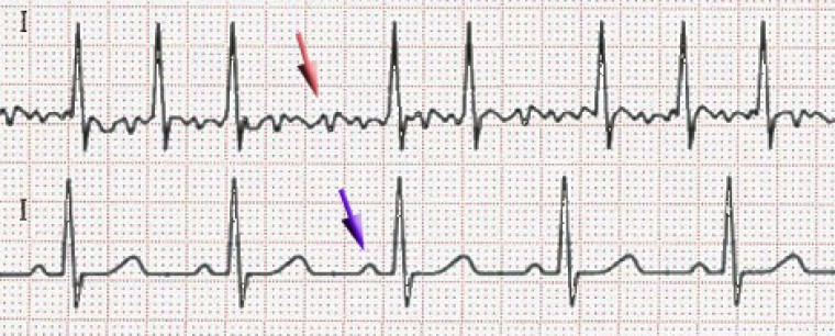 Особенности циркадных ритмов частоты сердечных сокращений у пациентов с пароксизмами фибрилляции предсердий