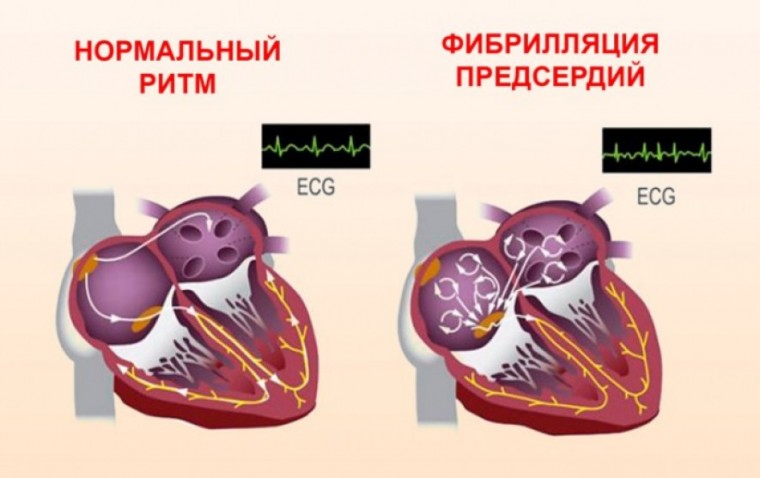 Оценка циркадианного ритма частоты сердечных сокращений при пароксизмальной фибрилляции предсердий